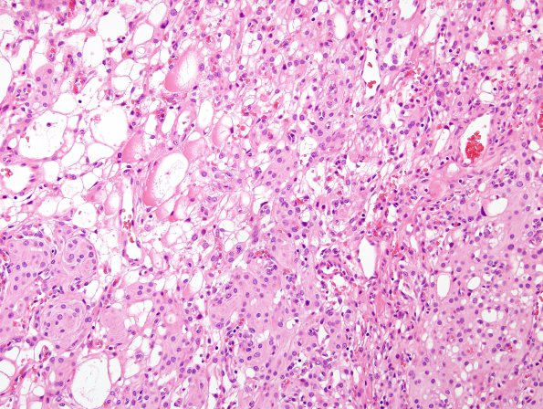 13A1 Meningioma, atypical, microcystic-clear cell (Case 13) H&E 1