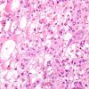 13A2 Meningioma, atypical, microcystic-clear cell (Case 13) H&E 2