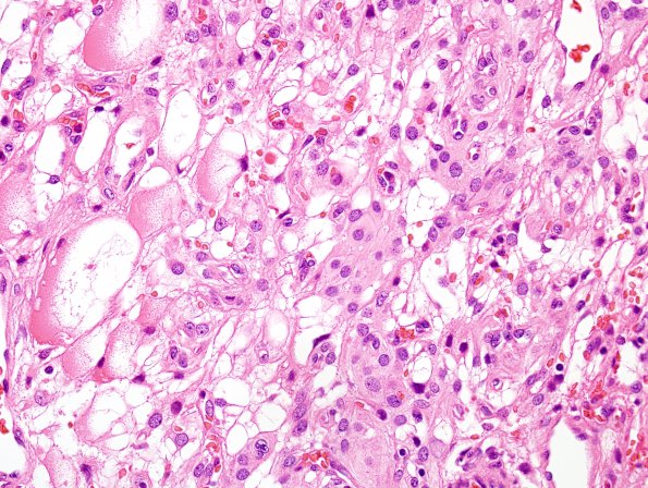 13A2 Meningioma, atypical, microcystic-clear cell (Case 13) H&E 2