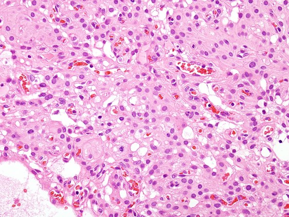 13A3 Meningioma, atypical, microcystic-clear cell (Case 13) H&E 3