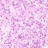 13A4 Meningioma, atypical, microcystic-clear cell (Case 13) H&E 5