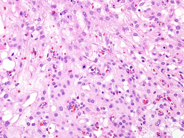 13A4 Meningioma, atypical, microcystic-clear cell (Case 13) H&E 5