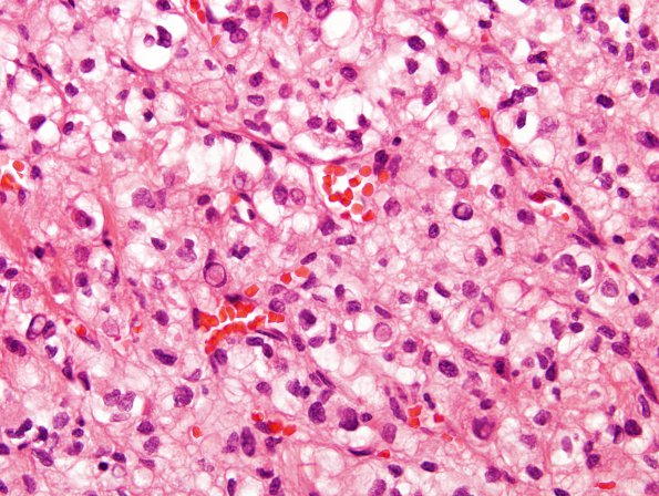 14A1 Meningioma, Clear cell variant (Case 14)  1