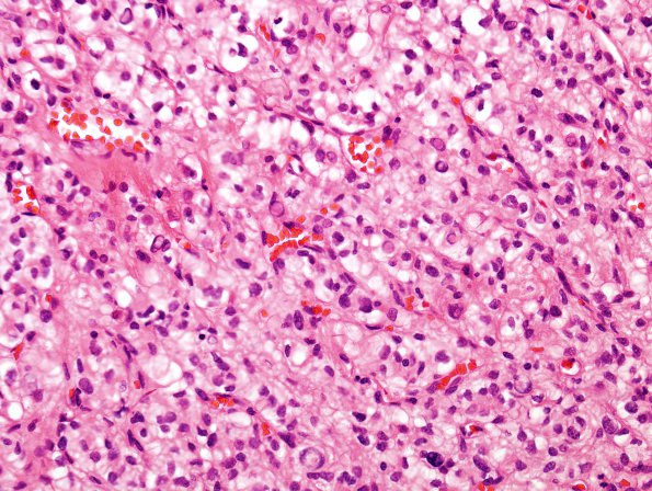 14A2 Meningioma, Clear cell variant (Case 14)