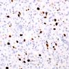 14B Meningioma, Clear cell variant (Case 14) MIB