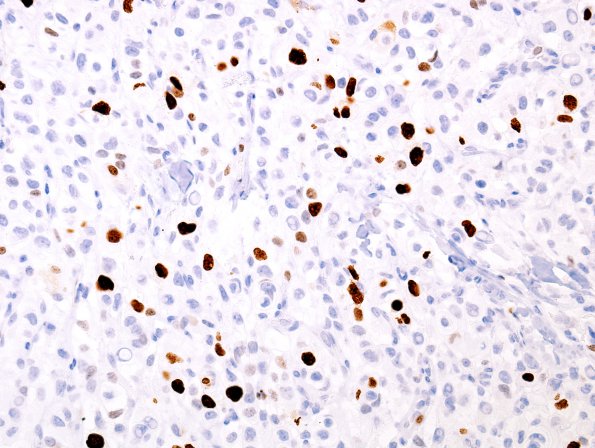 14B Meningioma, Clear cell variant (Case 14) MIB