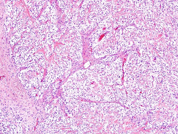 15A1 Meningioma, clear cell (AANP 2004-Case 1) H&E 3