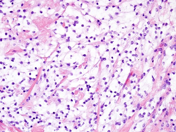 15A2 Meningioma, clear cell (AANP 2004-Case 1) H&E 1