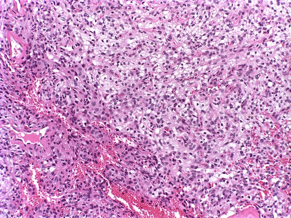 16A1 Meningioma, Clear cell part (Case 16) b