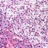 16A2 Meningioma, Clear cell part (Case 16) a