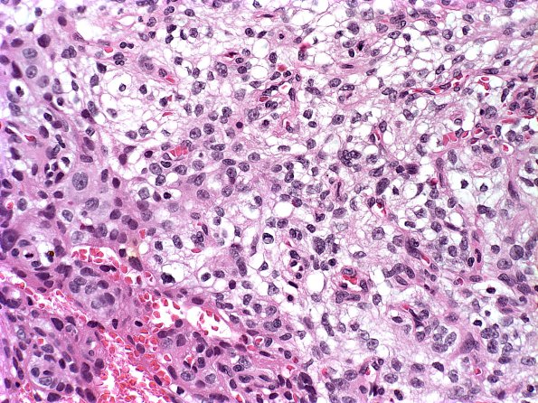 16A2 Meningioma, Clear cell part (Case 16) a