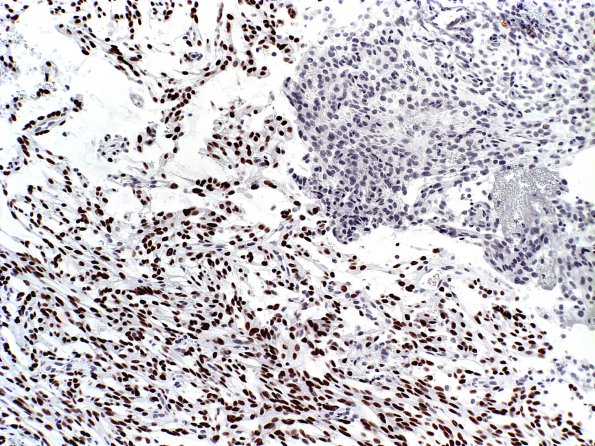 16B Meningioma, (Case 16) PR a