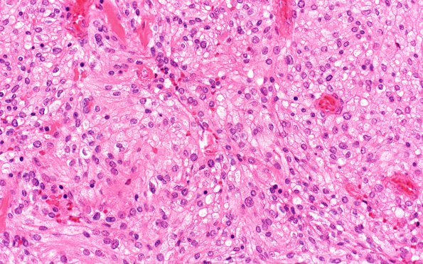 17A2 Clear cell meningioma (Case 17) H&E 40X