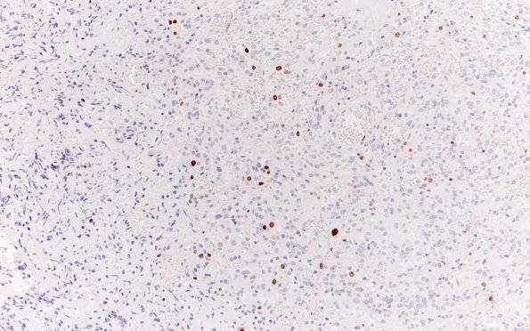 17C Clear cell meningioma (Case 17) Ki67 20X 2