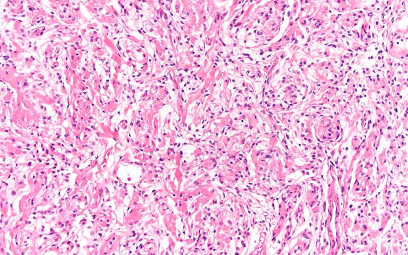 19A2 Clear cell Meningioma (Case 19) H&E 20X 2