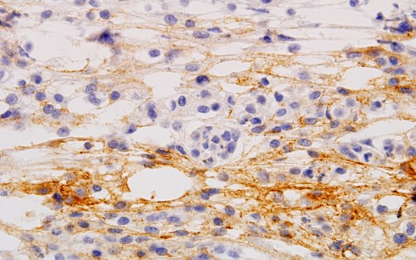 19B2 Clear cell Meningioma (Case 19) EMA 60X