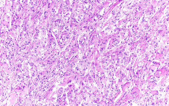 19C1 Clear cell Meningioma (Case 19) PAS 20X