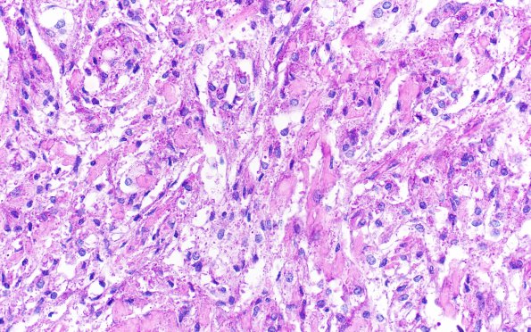 19C2 Clear cell Meningioma (Case 19) PAS 40X