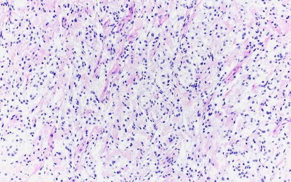 19D1 Clear cell Meningioma (Case 19) PAS W Diastase 20X