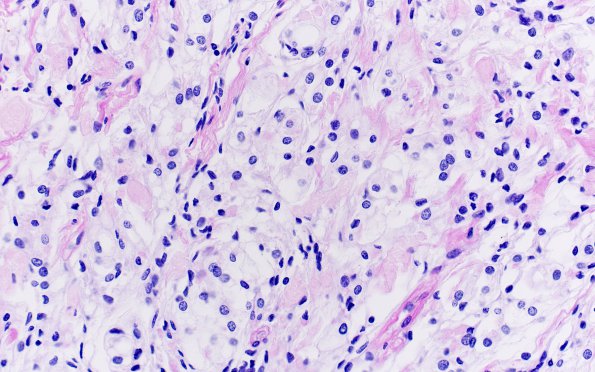 19D2 Clear cell Meningioma (Case 19) PAS W Diastase 40X