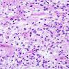 1A4 Meningioma, Clear cell type (Case 1)  H&E 2