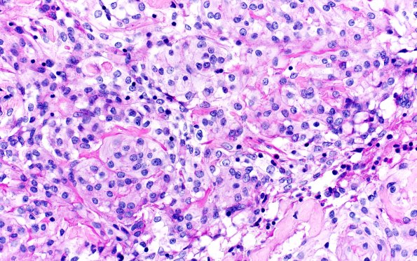 20C3 Clear cell meningioma (Case 20) PAS 40X 2