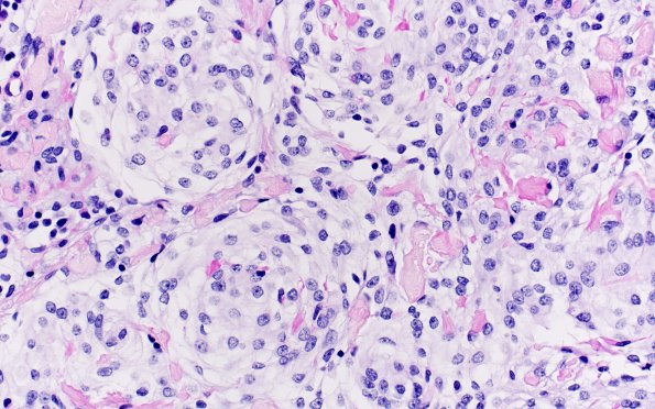 20D3 Clear cell meningioma (Case 20) PASW 40X 2