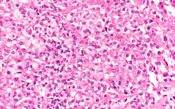 21A2 Clear cell meningioma (Case 21) H&E 40X