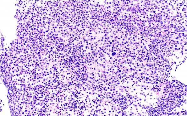 21D1 Clear cell meningioma (Case 21) PASD 20X