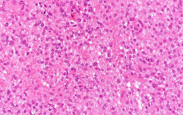 22A2 Meningioma, clear cell (Case 22) H&E 40X