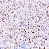 22B Meningioma, clear cell (Case 22) PR 40X