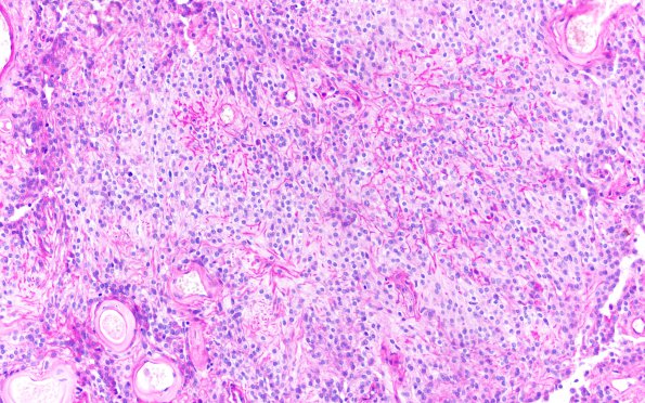 22C2 Meningioma, clear cell (Case 22) PAS 20X