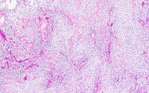 22D1 Meningioma, clear cell (Case 22) PAS-D 10X