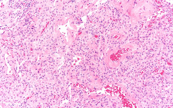 23A3 Clear cell meningioma (Case 23) H&E 20X (2)