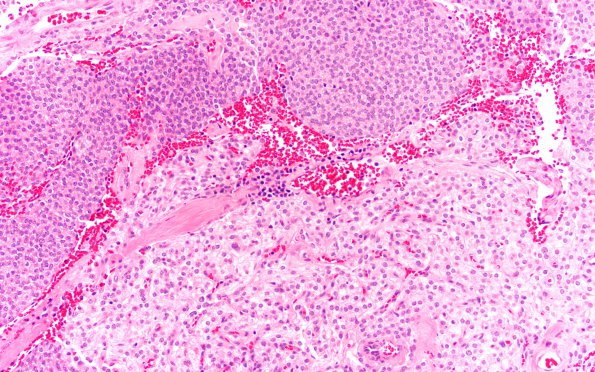 23A4 Clear cell meningioma (Case 23) H&E 20X