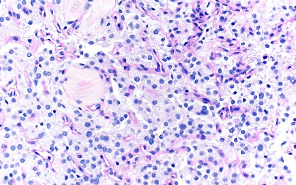 23B1 Clear cell meningioma (Case 23) PAS-D 20X