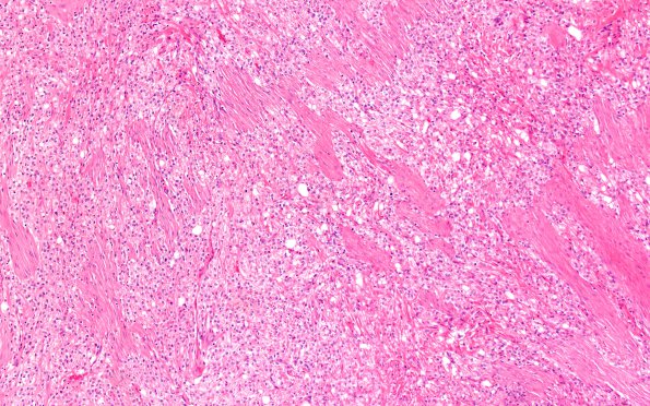 24A1 Clear cell meningioma (Case 24) H&E 10X 2