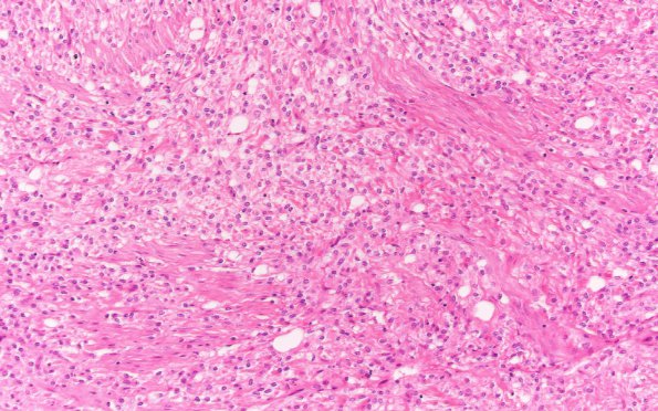 24A2 Clear cell meningioma (Case 24) H&E 20X 2