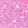 24A3 Clear cell meningioma (Case 24) H&E 40X 2