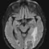 25A1 Meningioma, clear cell & whorling-sclerosing (Case 25) FLAIR