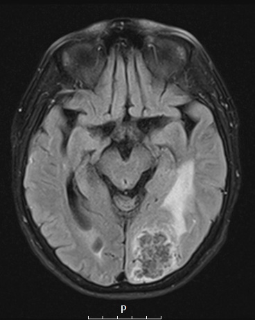 25A1 Meningioma, clear cell & whorling-sclerosing (Case 25) FLAIR