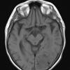 25A2 Meningioma, clear cell & whorling-sclerosing (Case 25) T1noC