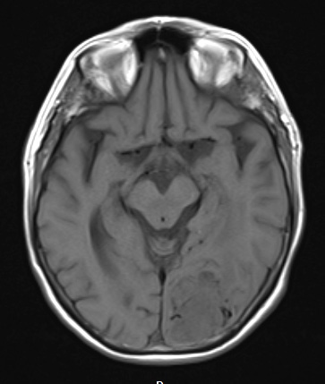 25A2 Meningioma, clear cell & whorling-sclerosing (Case 25) T1noC