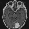 25A3 Meningioma, clear cell & whorling-sclerosing (Case 25) T1W