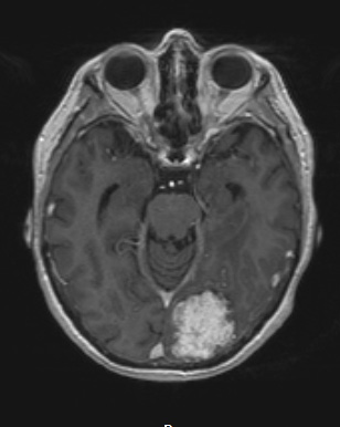 25A3 Meningioma, clear cell & whorling-sclerosing (Case 25) T1W