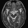 25A4 Meningioma, clear cell & whorling-sclerosing (Case 25) T2 A