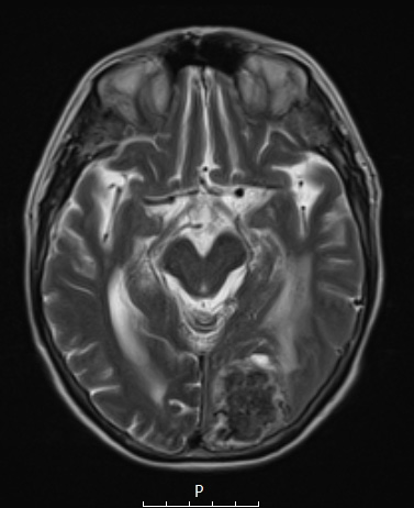 25A4 Meningioma, clear cell & whorling-sclerosing (Case 25) T2 A