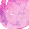 25B1 Meningioma, clear cell & Whorling Sclerosing (Case 25) H&E 2X