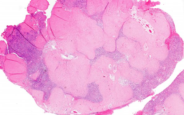 25B1 Meningioma, clear cell & Whorling Sclerosing (Case 25) H&E 2X