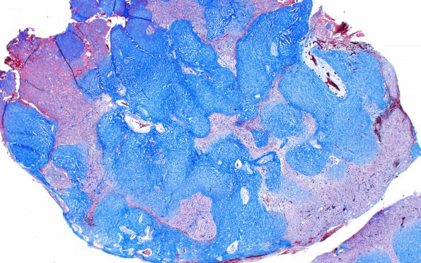 25B2 Meningioma, clear cell & Whorling Sclerosing (Case 25) Trichrome 2X